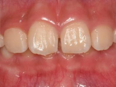 [성장기 교정] 치아 총생