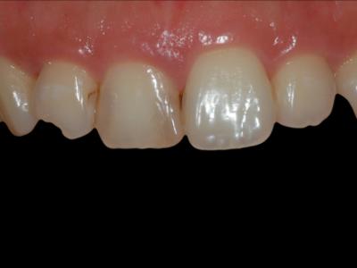 [심미 치료] 치아 형태, 잇몸 라인 개선