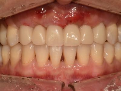 [임플란트] 고난이도 잇몸 뼈이식 사례